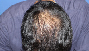 30代 男性 H.K.さん 生え際・頭頂部の自毛植毛（MIRAI法） 3,000株の症例（施術後）