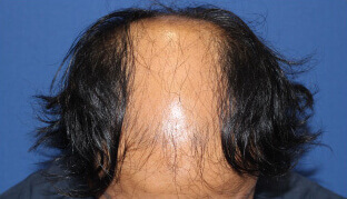 30代 男性 H.K.さん 生え際・頭頂部の自毛植毛（MIRAI法） 3,000株の症例（施術前）