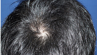 30代 男性 H.M.さん 頭頂部の自毛植毛（MIRAI法） 800株の症例（施術後）