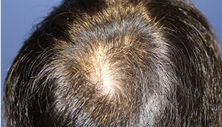 30代 男性 H.M.さん 頭頂部の自毛植毛（MIRAI法） 800株の症例（施術前）