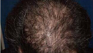 40代 男性 H.Y.さん 頭頂部の自毛植毛（MIRAI法） 3,000株の症例（施術後）
