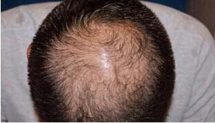 40代 男性 H.Y.さん 頭頂部の自毛植毛（MIRAI法） 3,000株の症例（施術前）
