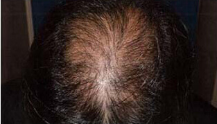 50代 男性 I.H.さん 頭頂部の自毛植毛（MIRAI法） 2,700株の症例（施術後）
