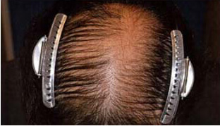 50代 男性 I.H.さん 頭頂部の自毛植毛（MIRAI法） 2,700株の症例（施術前）