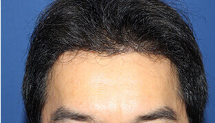 	40代 男性 I.K.さん 生え際の自毛植毛（MIRAI法） 1,800株の症例（施術後）
