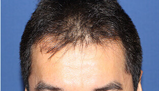 	40代 男性 I.K.さん 生え際の自毛植毛（MIRAI法） 1,800株の症例（施術前）