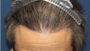 50代 男性 I.M.さん 生え際・前頭部の自毛植毛（NC-MIRAI法） 1,000株の症例（施術後）