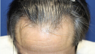 50代 男性 I.M.さん 生え際・前頭部の自毛植毛（NC-MIRAI法） 1,000株の症例（施術前）