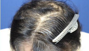 50代 男性 I.M.さん 生え際・前頭部の自毛植毛（NC-MIRAI法） 1,000株の症例（施術前）