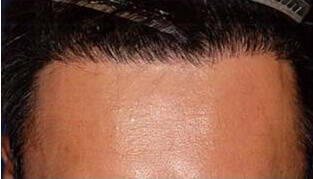 40代 男性 I.M.さん 生え際の自毛植毛（MIRAI法） 1,350株の症例（施術後）