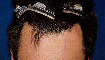 40代 男性 I.M.さん 生え際の自毛植毛（MIRAI法） 1,350株の症例（施術前）