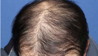 20代 男性 K.D.さん 前頭部・頭頂部の自毛植毛（MIRAI法） 2,400株の症例（施術後）