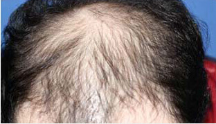 20代 男性 K.D.さん 前頭部・頭頂部の自毛植毛（MIRAI法） 2,400株の症例（施術前）