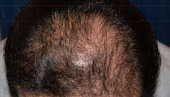 40代 男性 K.I.さん 頭頂部の自毛植毛（MIRAI法） 2,000株の症例（施術後）