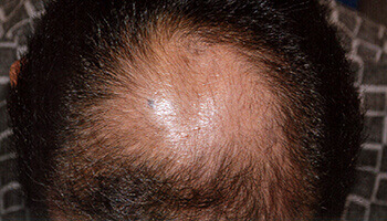 40代 男性 K.I.さん 頭頂部の自毛植毛（MIRAI法） 2,000株の症例（施術前）