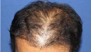40代 男性 K.K.さん 生え際・頭頂部の自毛植毛（MIRAI法） 2,400株の症例（施術後）