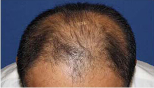 40代 男性 K.K.さん 生え際・頭頂部の自毛植毛（MIRAI法） 2,400株の症例（施術前）