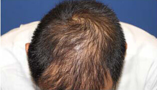 40代 男性 K.K.さん 前頭部・頭頂部の自毛植毛（MIRAI法） 2,000株の症例（施術後）