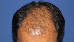 40代 男性 K.K.さん 前頭部・頭頂部の自毛植毛（MIRAI法） 2,000株の症例（施術前）