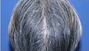 60代 男性 K.K.さん 前頭部・頭頂部の自毛植毛（MIRAI法） 1,500株の症例（施術後）