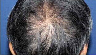 60代 男性 K.K.さん 前頭部・頭頂部の自毛植毛（MIRAI法） 1,500株の症例（施術前）