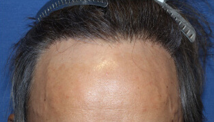40代 男性 K.M.さん 生え際の自毛植毛（MIRAI法） 500株の症例（施術後）