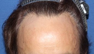 40代 男性 K.M.さん 生え際の自毛植毛（MIRAI法） 500株の症例（施術前）