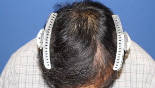 50代 男性 K.M.さん 前頭部・頭頂部の自毛植毛（MIRAI法） 3,000株の症例（施術後）