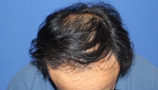 50代 男性 K.M.さん 前頭部・頭頂部の自毛植毛（MIRAI法） 3,000株の症例（施術前）