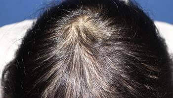 40代 女性 K.M.さん 頭頂部の自毛植毛（MIRAI法） 1,500株の症例（施術後）
