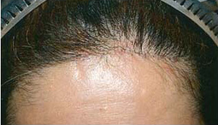 50代 女性 K.M.さん 前頭部・分け目の自毛植毛（NC-MIRAI法） 1,100株の症例（施術後）