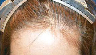 50代 女性 K.M.さん 前頭部・分け目の自毛植毛（NC-MIRAI法） 1,100株の症例（施術前）