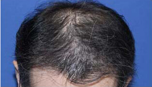 40代 男性 K.S.さん 前頭部の自毛植毛（MIRAI法） 1,400株の症例（施術後）