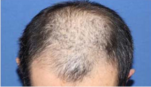 40代 男性 K.S.さん 前頭部の自毛植毛（MIRAI法） 1,400株の症例（施術前）
