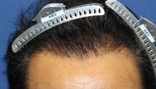 40代 男性 K.R.さん 生え際の自毛植毛（NC-MIRAI法） 1,600株の症例（施術後）