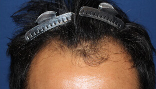 40代 男性 K.R.さん 生え際の自毛植毛（NC-MIRAI法） 1,600株の症例（施術前）
