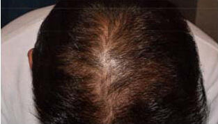 40代 男性 K.T.さん 頭頂部の自毛植毛（NC-MIRAI法） 600株の症例（施術後）