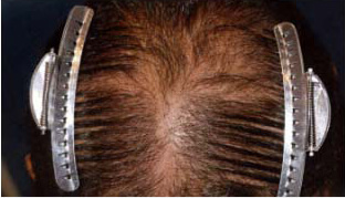 40代 男性 K.T.さん 頭頂部の自毛植毛（NC-MIRAI法） 600株の症例（施術前）