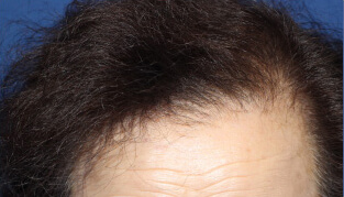 70代 女性 M.A.さん 前頭部の自毛植毛（NC-MIRAI法） 1,200株の症例（施術後）