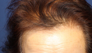 70代 女性 M.A.さん 前頭部の自毛植毛（NC-MIRAI法） 1,200株の症例（施術前）