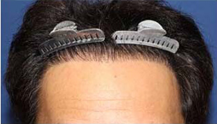 40代 男性 M.H.さん 生え際の自毛植毛（MIRAI法） 2,000株の症例（施術後）