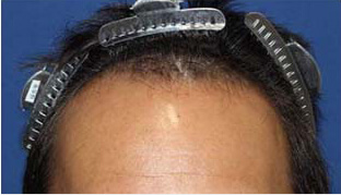 40代 男性 M.H.さん 生え際の自毛植毛（MIRAI法） 2,000株の症例（施術前）