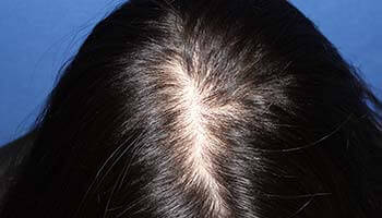 30代 女性 M.K.さん 頭頂部の自毛植毛（MIRAI法） 200株の症例（施術前）