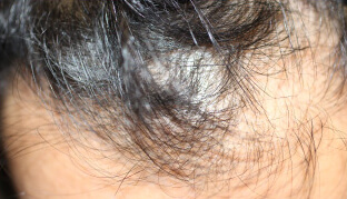 30代 男性 M.Y.さん 生え際・前頭部の自毛植毛（MIRAI法） 2,000株の症例（施術前）
