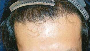 30代 男性 M.Y.さん 生え際の自毛植毛（MIRAI法） 1,500株｜自毛植毛の症例（施術後）