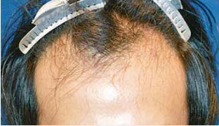 30代 男性 M.Y.さん 生え際の自毛植毛（MIRAI法） 1,500株｜自毛植毛の症例（施術前）