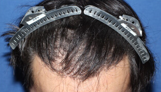 30代 男性 N.A.さん 生え際・前頭部の自毛植毛（MIRAI法） 2,000株の症例（施術後）
