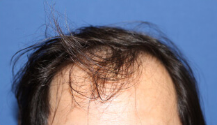 30代 男性 N.A.さん 生え際・前頭部の自毛植毛（MIRAI法） 2,000株の症例（施術前）
