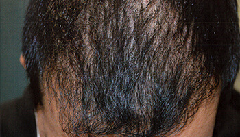 30代 男性 N.H.さん 前頭部・頭頂部の自毛植毛（MIRAI法） 2,200株の症例（施術後）