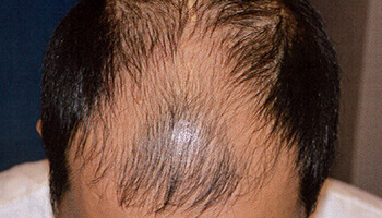 30代 男性 N.H.さん 前頭部・頭頂部の自毛植毛（MIRAI法） 2,200株の症例（施術前）